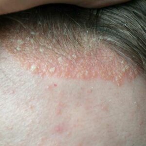 Scalp Psoriasis – Symptoms to Watch out For
