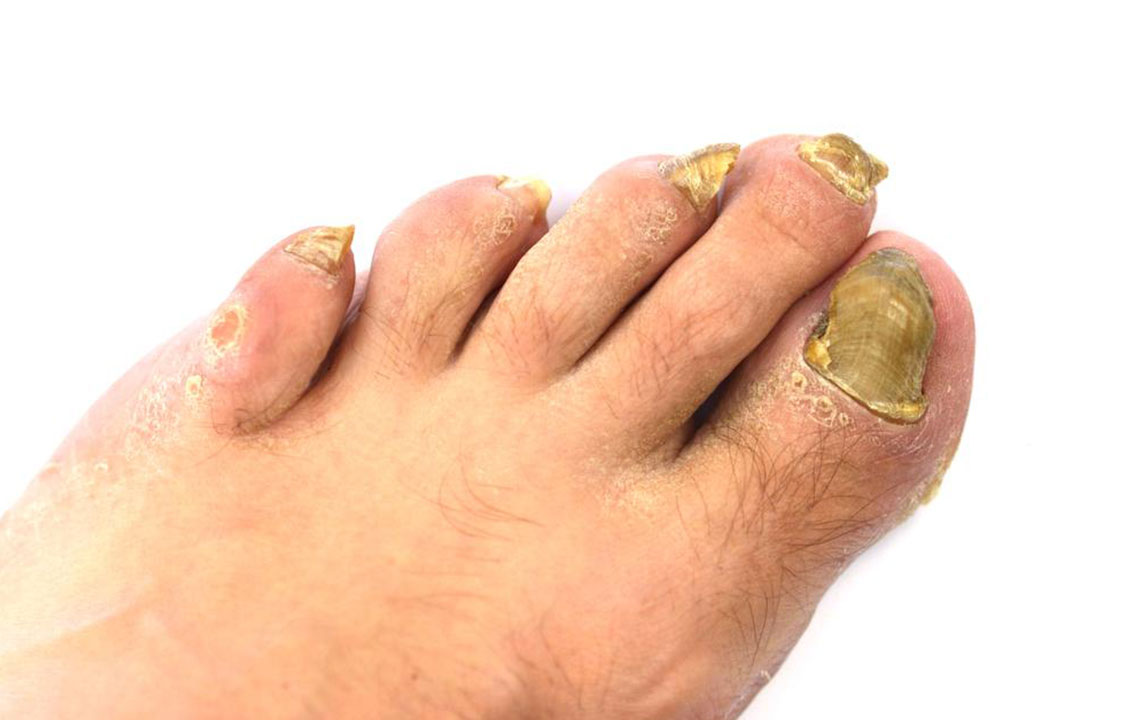 An Effective Way to Treat Toenail Fungus – Hydrogen Peroxide