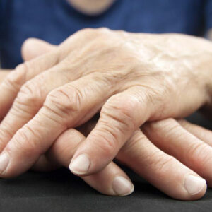 Rheumatoid Arthritis – Symptoms, Causes, and Remedies